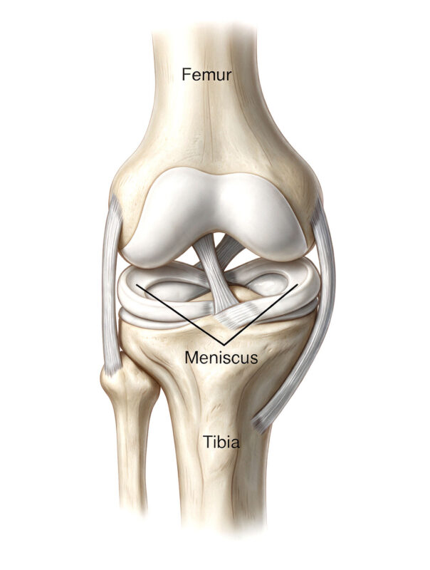 lesione-menisco_P3cSl7u42C anatomia del ginocchio