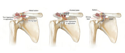 intervento per lussazione articolazione acromioclavicolare